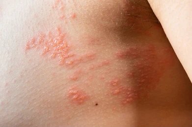herpes virus